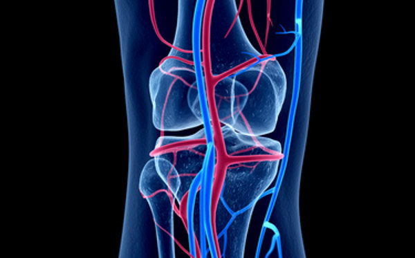 Arteriopatia degli arti inferiori