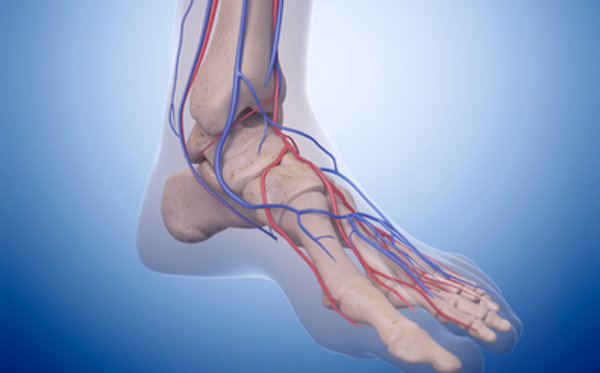 Ischemia critica degli arti inferiori