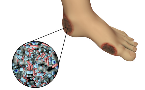 Piede diabetico vascolare